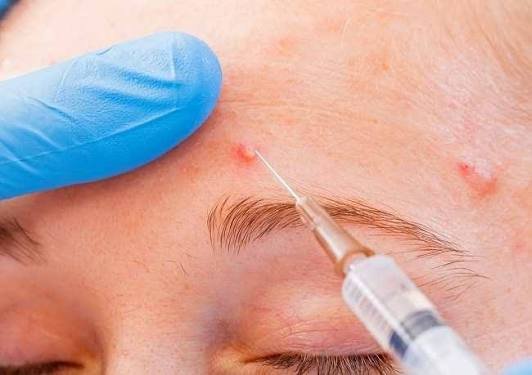 ACNE INJECTION KONDISI 1