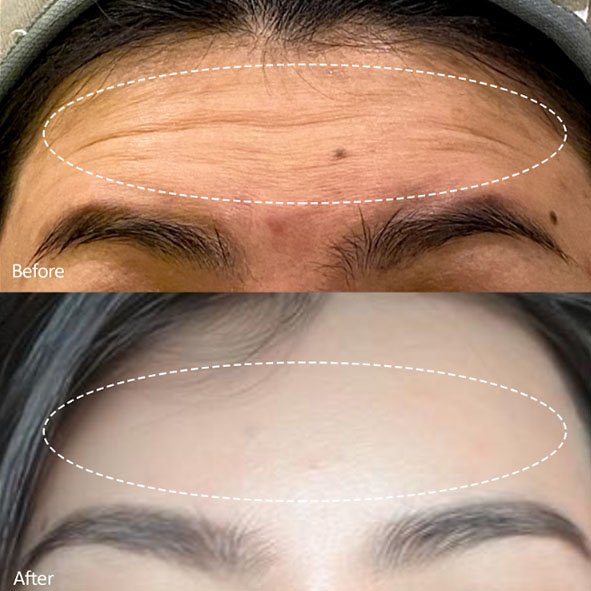 BOTOX UPPER FACE