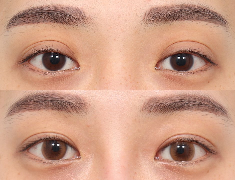 EYE LIFTING