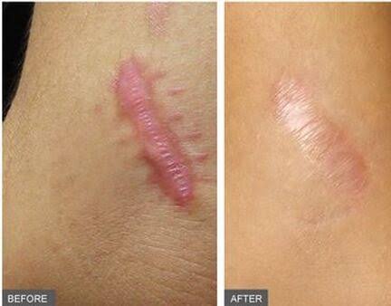 KELOID INJECTION KONDISI 3