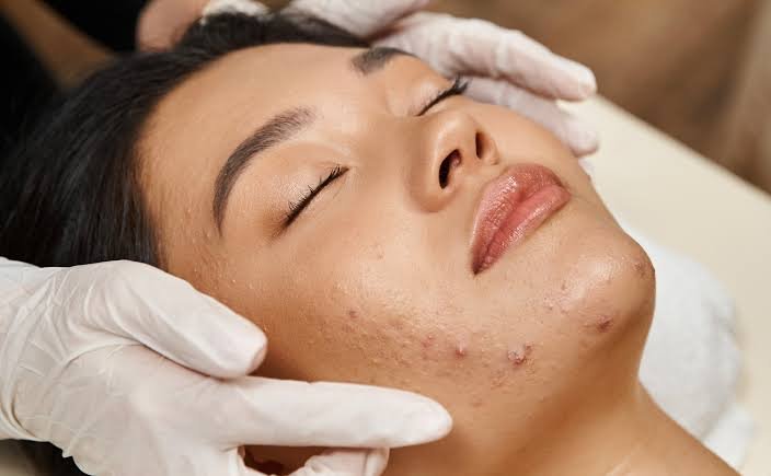 acne facial